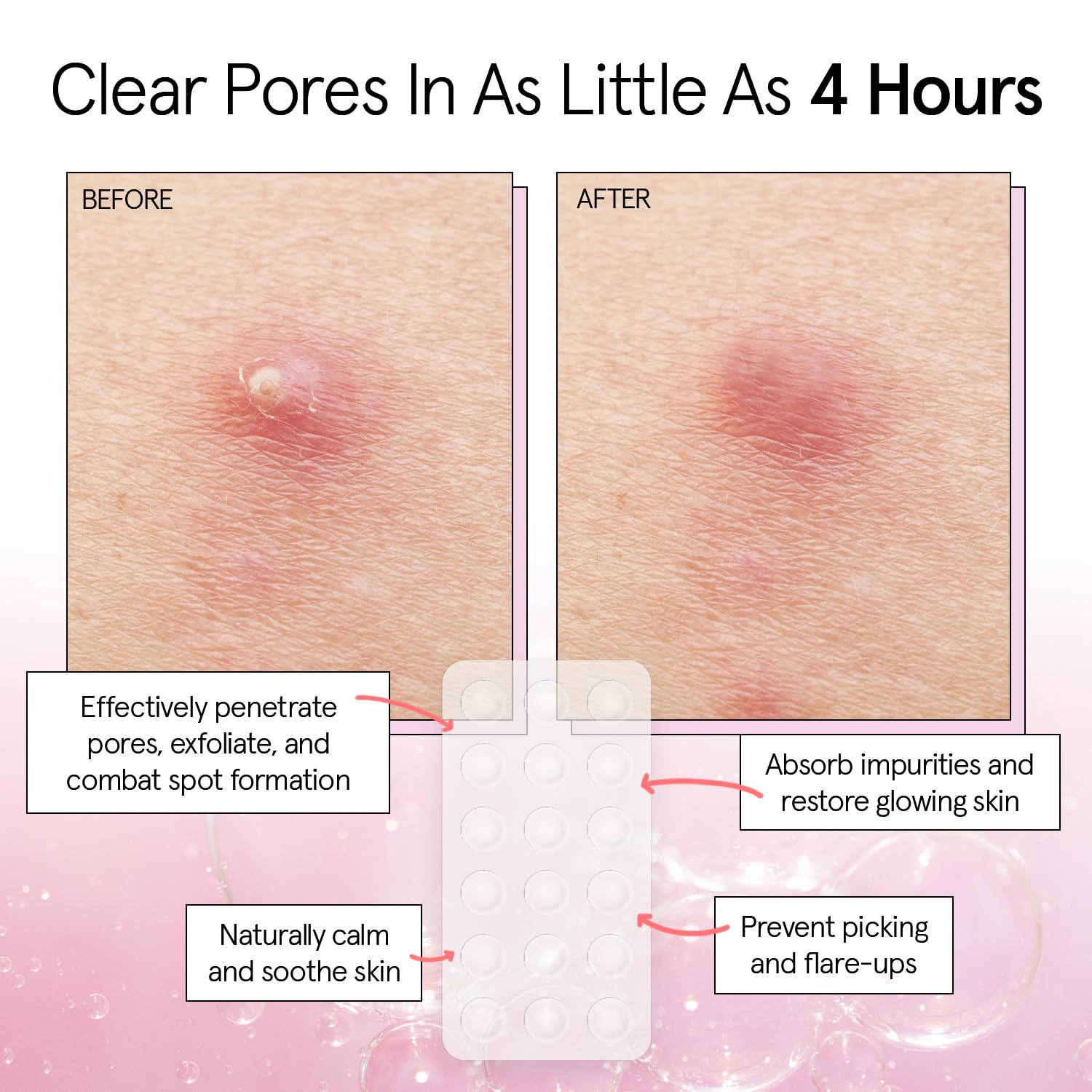 grace & stella Award Winning Pore Strip - Pimple Patches for Face - Hydrocolloid Acne Patches - Absorbs Zits, Reduces Redness - Cute Patches Dermatologist-Tested, Vegan (Multishape, 36 Count)